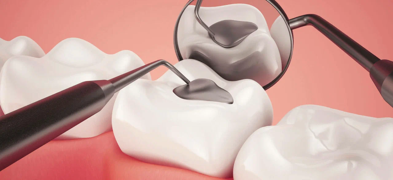 The Evolution of Dental Fillings: From Traditional Amalgam to Advanced Composites