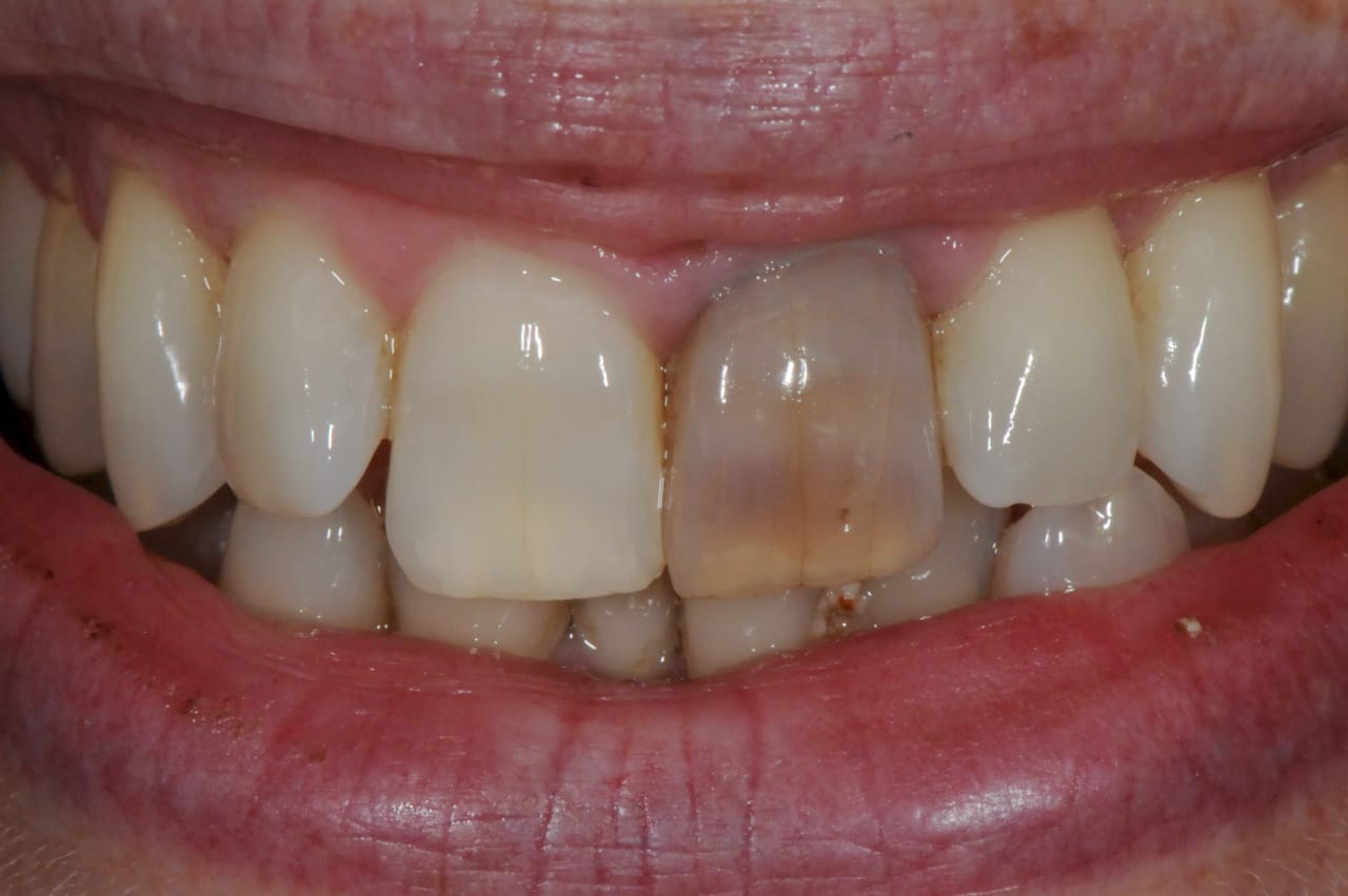 Silent Damage: What You Need to Know About Dental Trauma with No Visible Symptoms