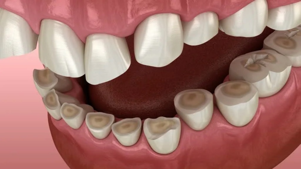 Bruxism and Bite Splints: What’s the Difference Between a Michigan Splint and a Nightguard?