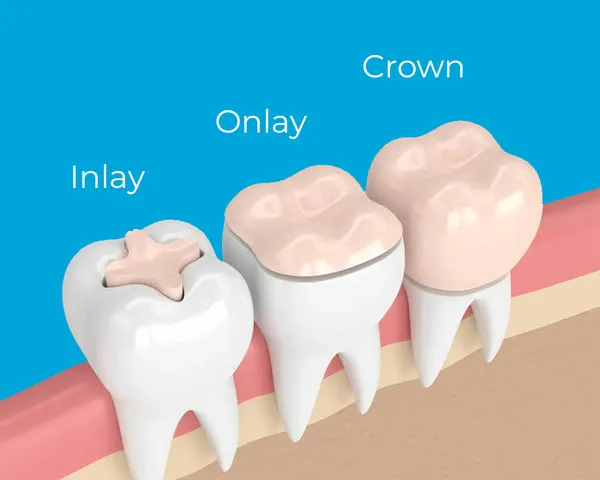 Dental Ceramic Onlays vs. Crowns: What’s the Difference and Which Is Right for You?