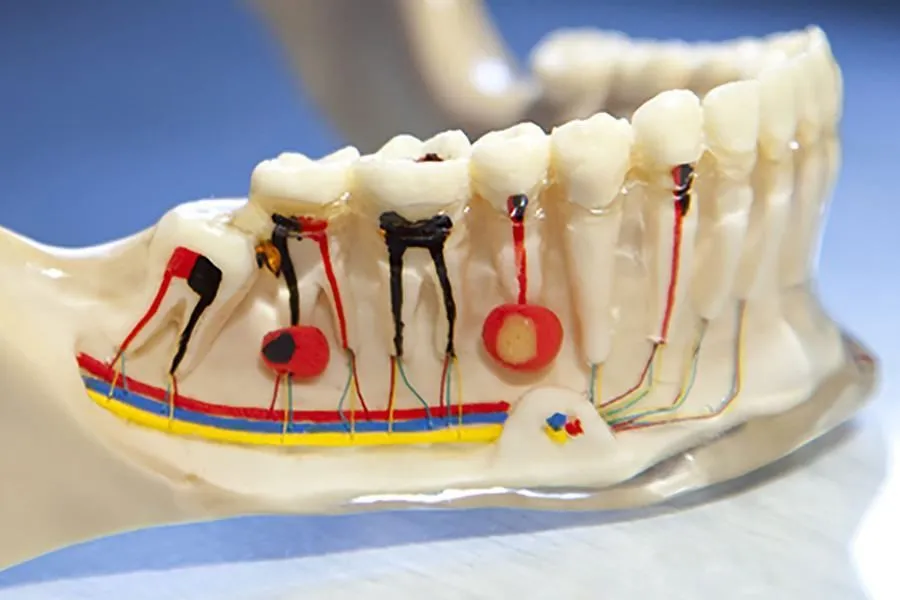 Common Endodontic Mishaps During Root Canal Treatment – Types, Causes, and Prevention