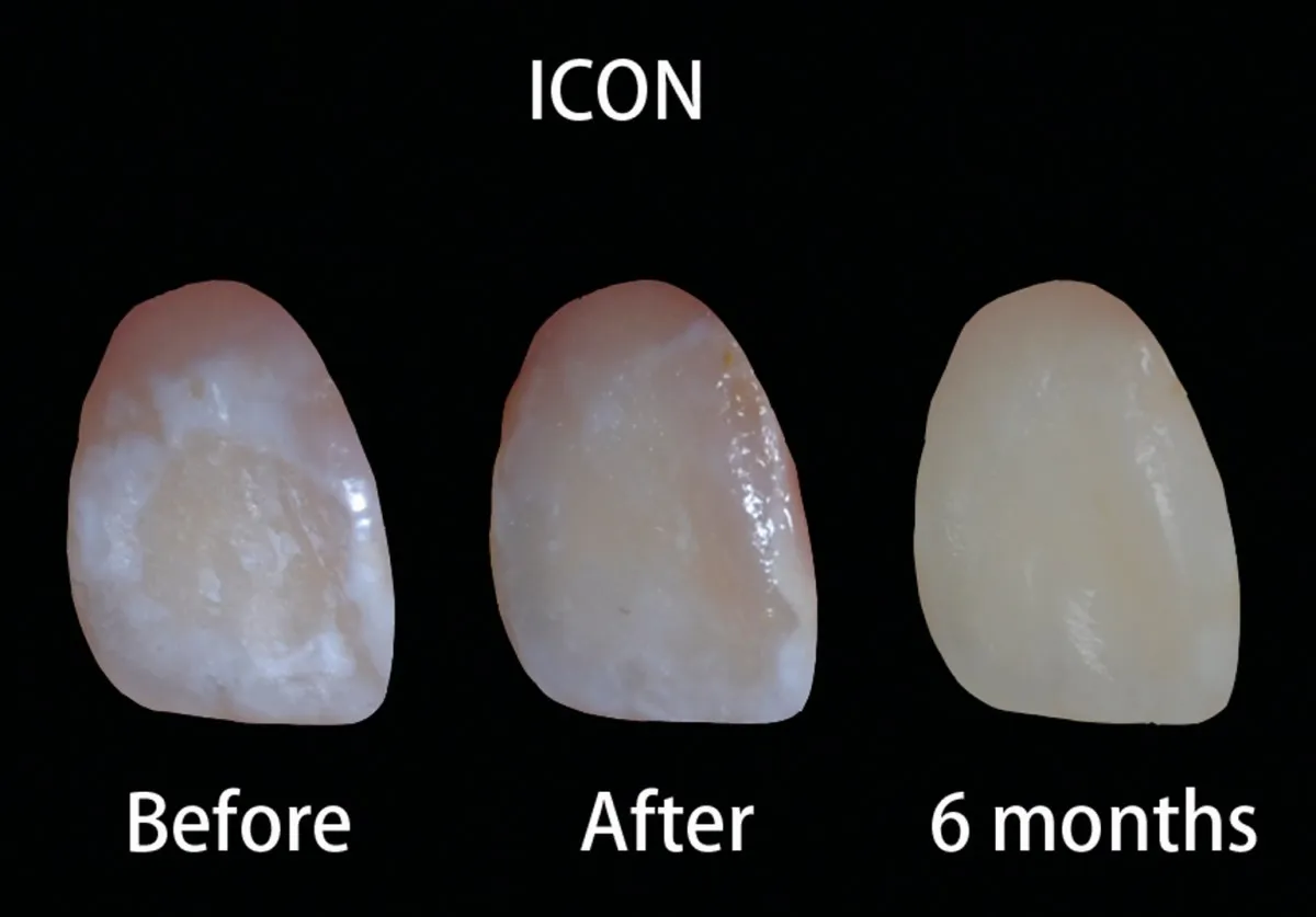 ICON Treatment for White Spot Lesions: A Minimally Invasive Solution