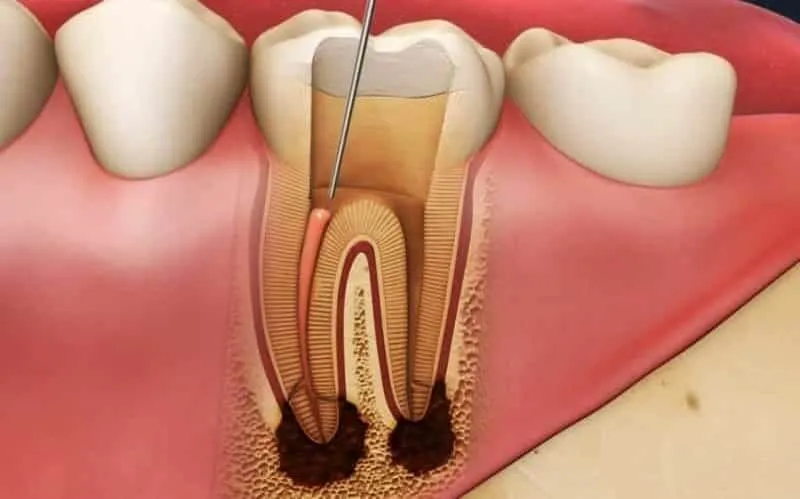 Why Do Root Canals Treatment Fail?