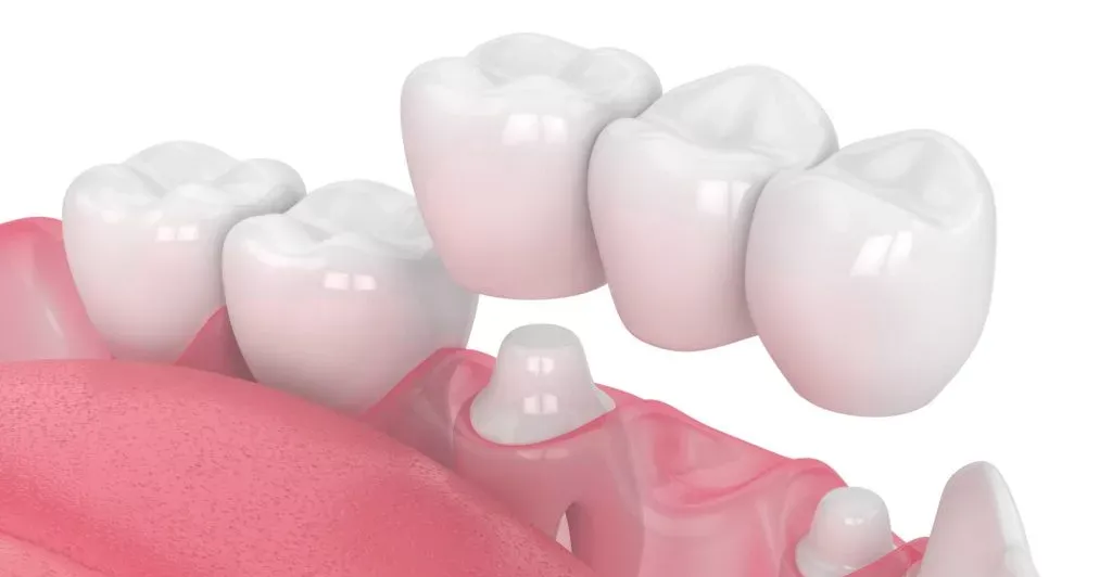 What is a dental bridge?