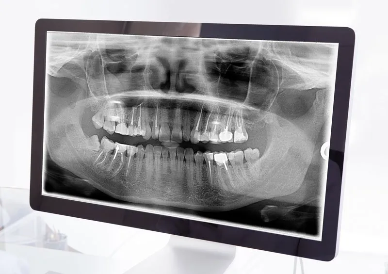 Why do we as dentists take an X-ray?