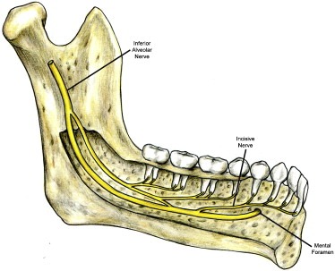 When Dental Infections Reach the Inferior Alveolar Nerve: Causes, Treatment & Lessons for Patients