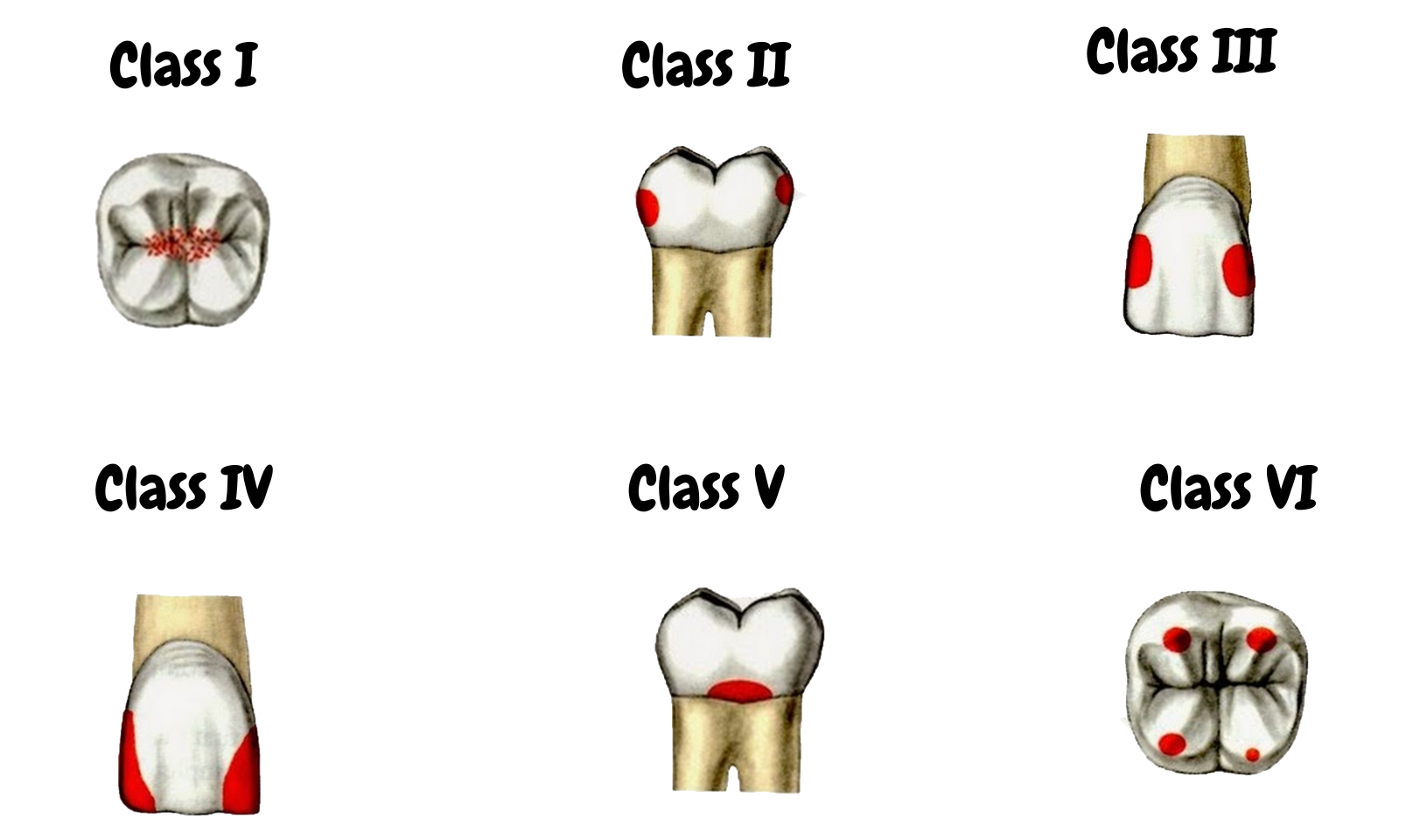 Classification of Dental Caries | Types & Severity Explained by Dr. Mohamad Hassoun