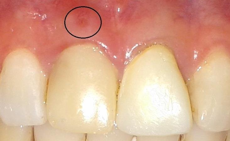 What Is a Sinus Tract (Dental Fistula)?