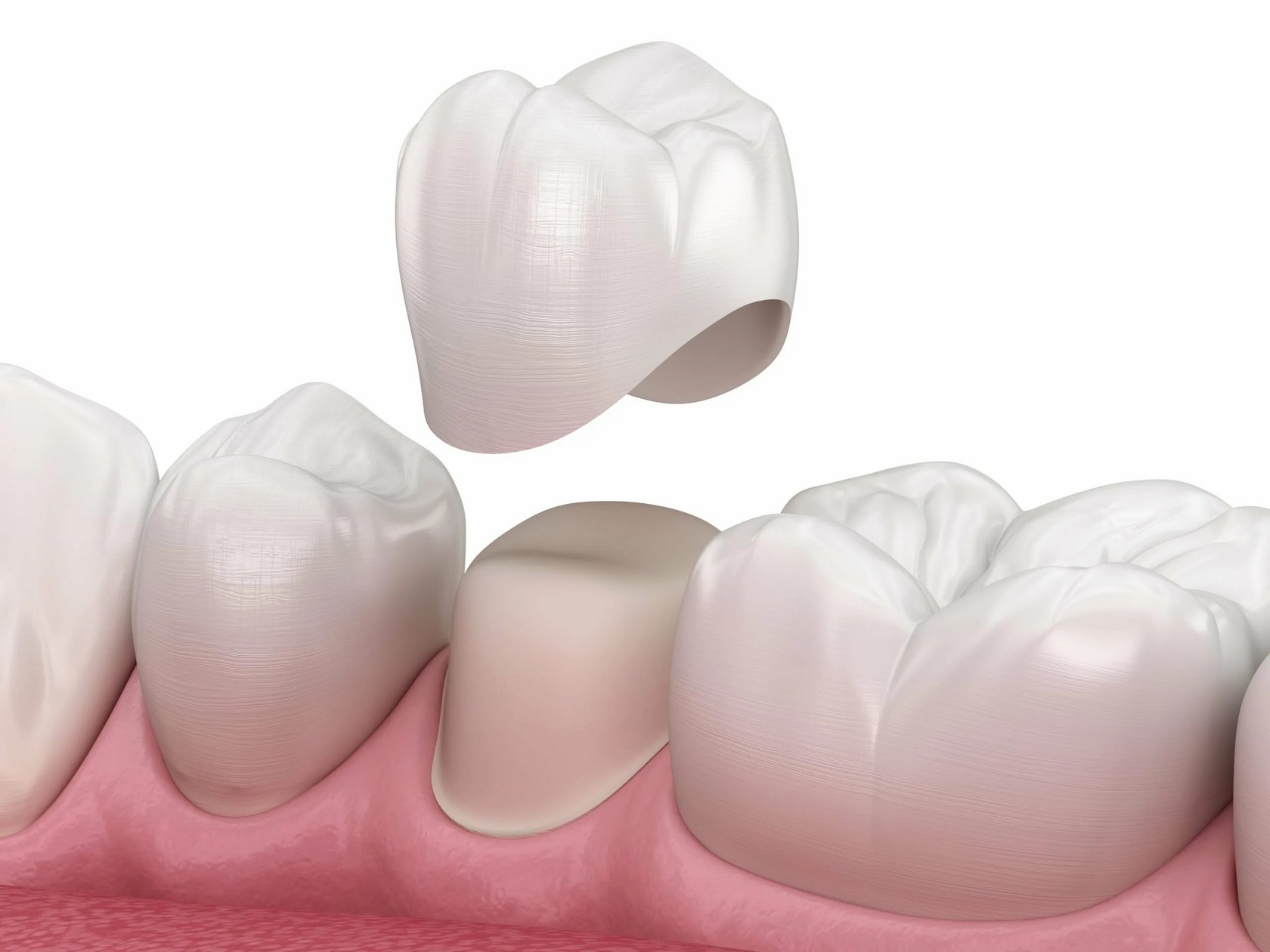 How We Make a Dental Crown: A Simple Guide for Patients