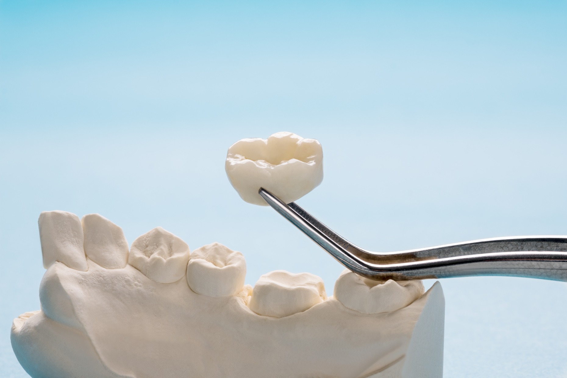 How We Make a Dental Crown: A Simple Guide for Patients