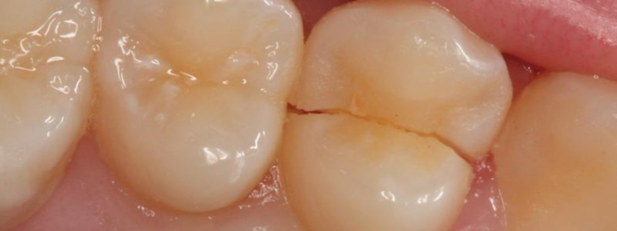 Cracked tooth syndrome: causes, symptoms and treatments