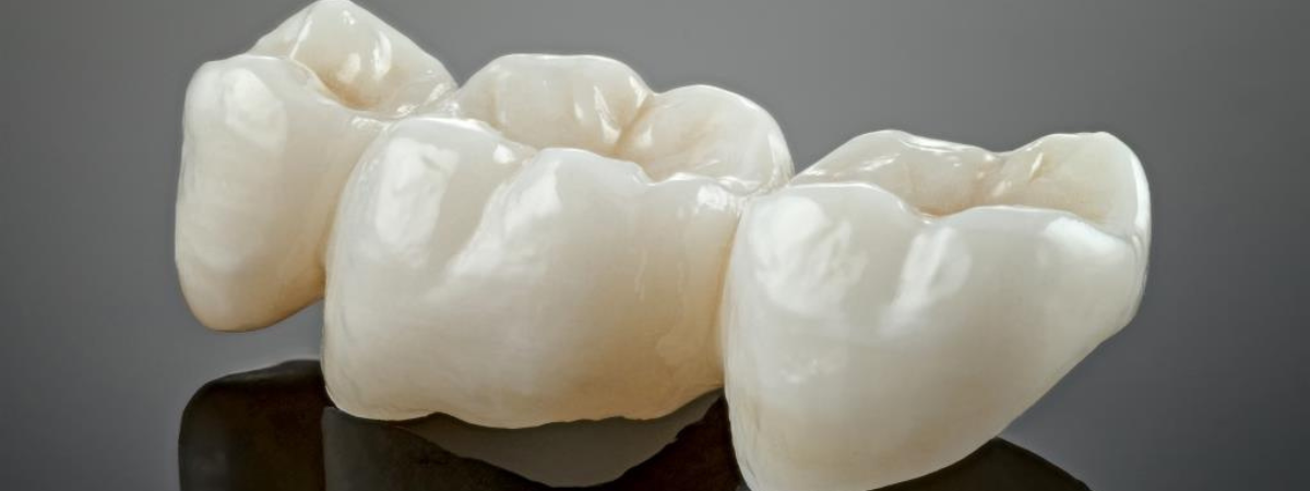 What is a dental bridge?