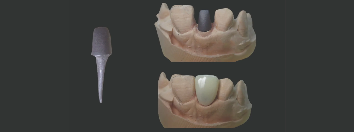 The difference between prefabricated and custom made posts