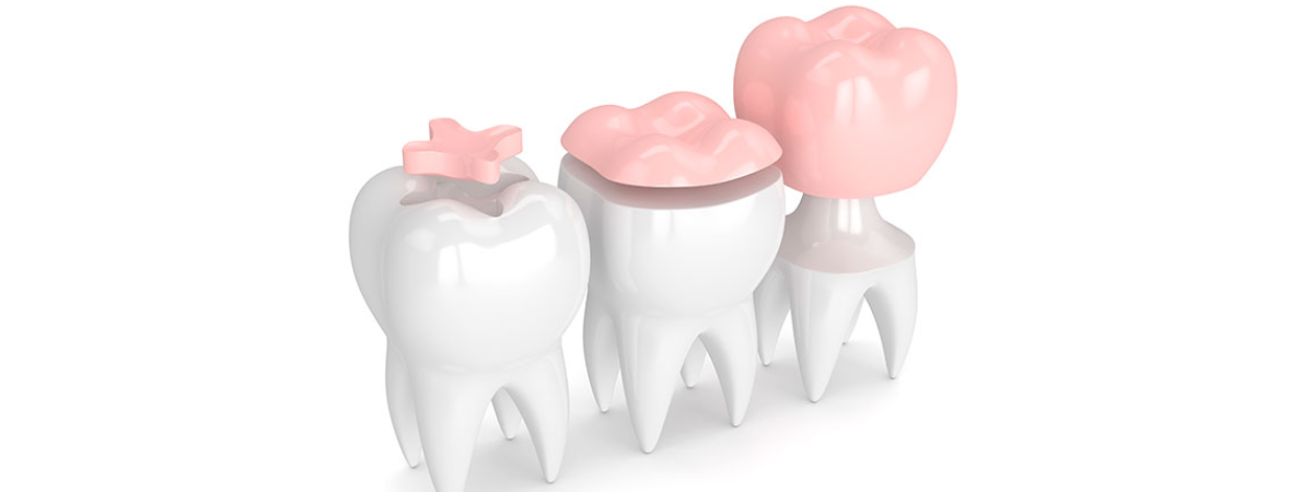 Dental Ceramic Onlays vs. Crowns: What’s the Difference and Which Is Right for You?