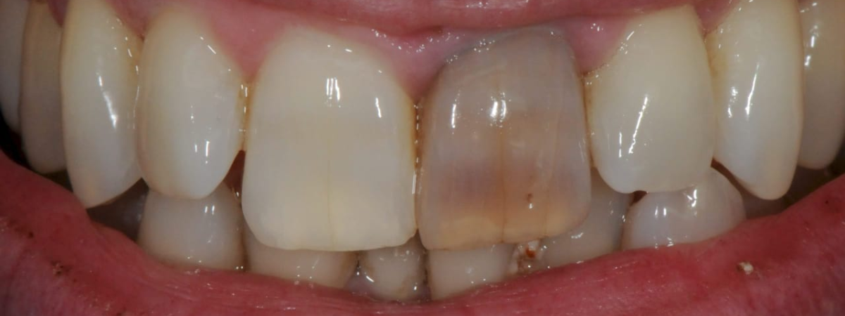 Silent Damage: What You Need to Know About Dental Trauma with No Visible Symptoms