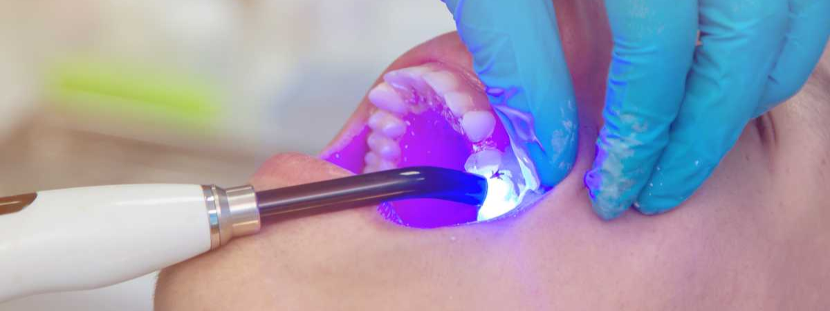 The Evolution of Dental Fillings: From Traditional Amalgam to Advanced Composites