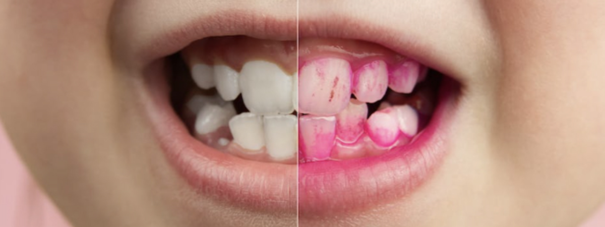 Brushing Brilliance: The Colorful World of Dental Dyes