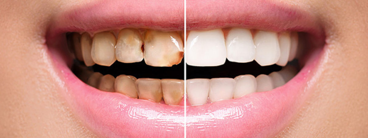 Dental Erosion: Causes, Symptoms & Treatment | Julphar Dental Clinic