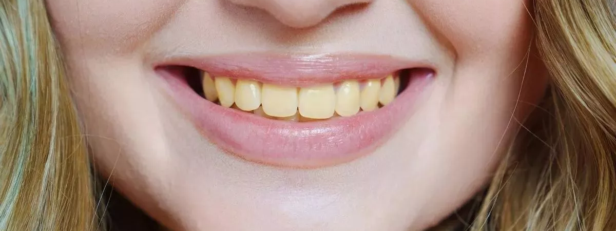 Why Do Teeth Become Yellow Even If You Brush Every Day?