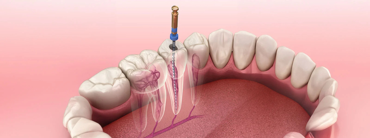 Common Endodontic Mishaps During Root Canal Treatment – Types, Causes, and Prevention