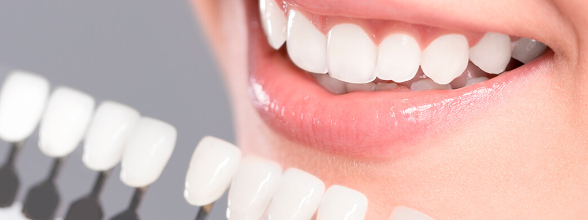 What are the Causes of Common Problems with Dental Veneers?