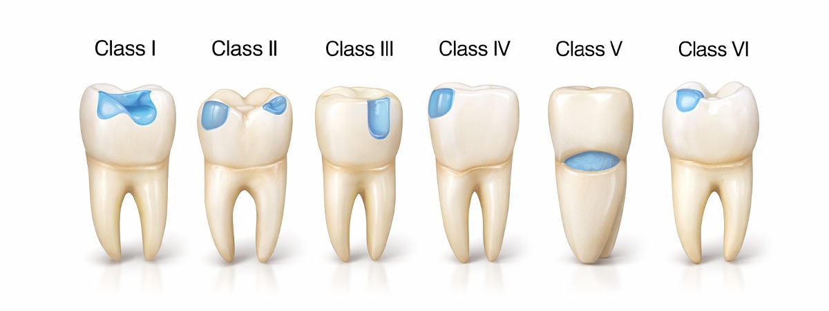 Classification of Dental Caries | Types & Severity Explained by Dr. Mohamad Hassoun
